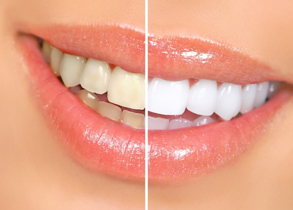 Advances in Teeth Whitening Procedures