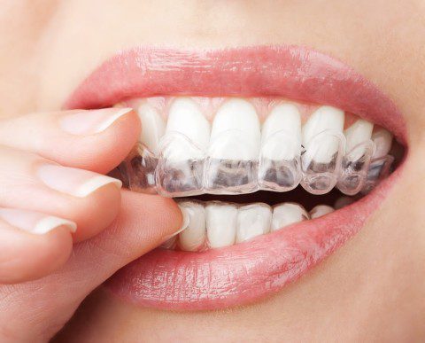 Local Dentist in Greenville, SC Can Give You Whiter Teeth in Less Time
