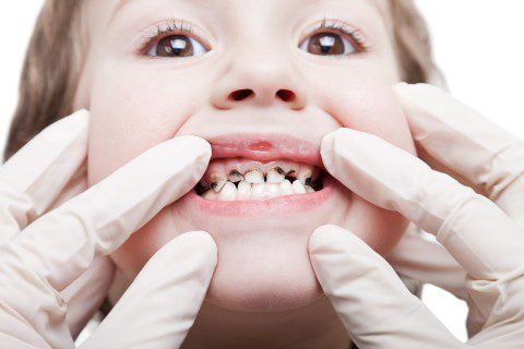 Capable Greenville Dentists Can Treat Severe Tooth Decay and Toothache