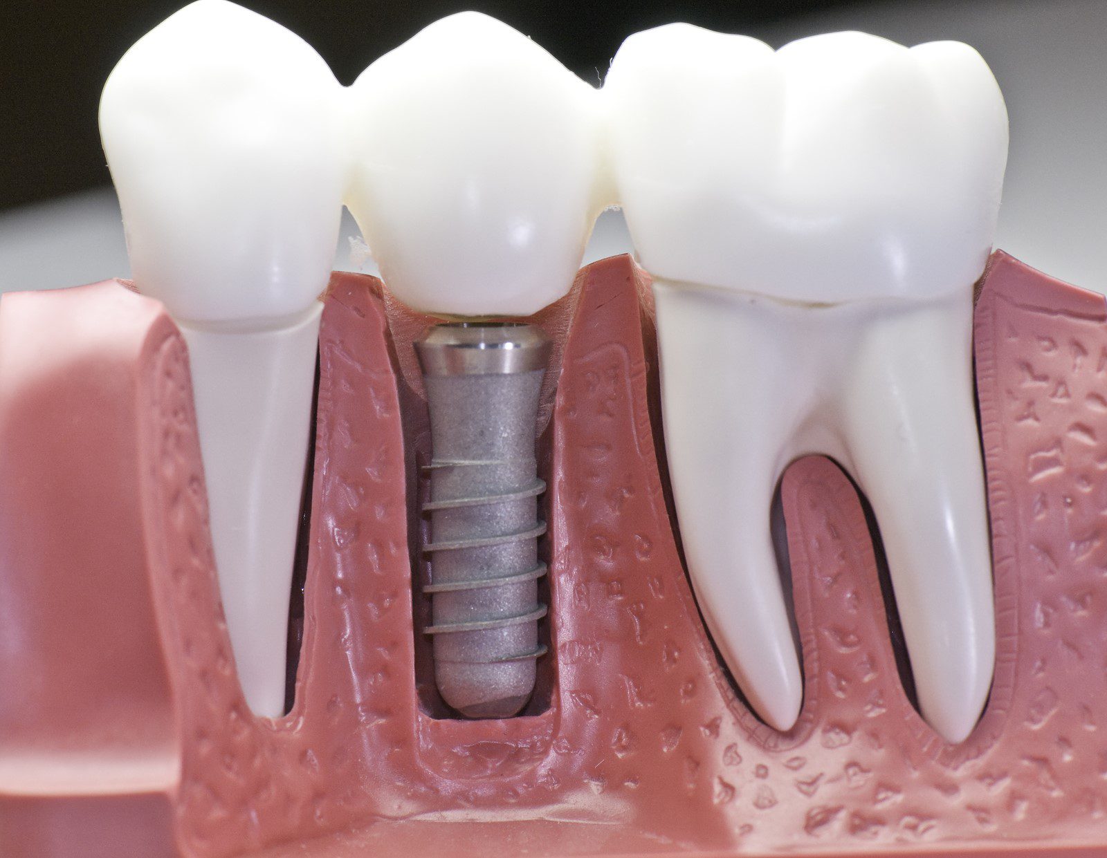 The Connection Between Dental Implants and Osteoporosis A Quick Look