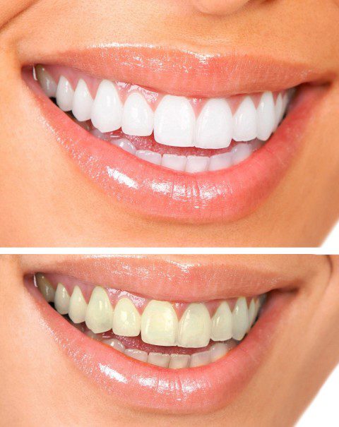 Visit Your Dentist Amazing Benefits of Professional Teeth Whitening