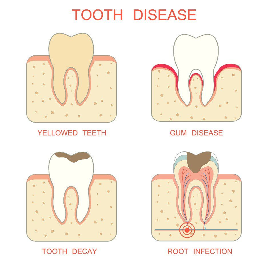 Tooth Disease Diagram
