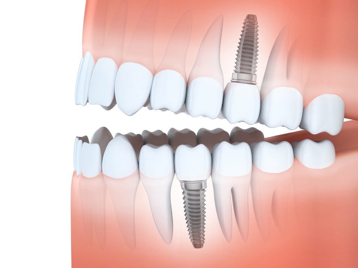 dental implants missing teeth